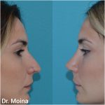 Rinoplastia Antes y Después. Resultado Natural. Dr. Moina