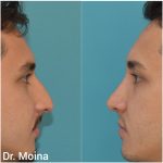 Rinoplastia en Hombre - Resultado Natural - Dr. Moina