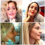 Rinoplastia Resultado Real - Dr. Moina